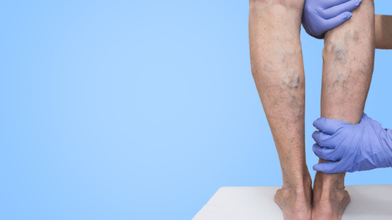 Varicose Veins: Meaning, Causes and Symptoms