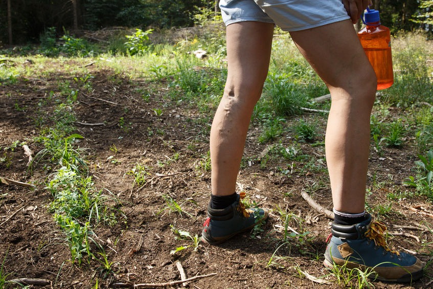 Woman with painful varicose veins on legs resting on a walk through nature.