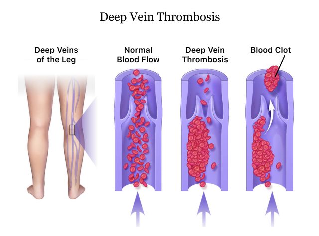Medfin BlogWhat Is Deep Vein Thrombosis DVT Is It Preventable 