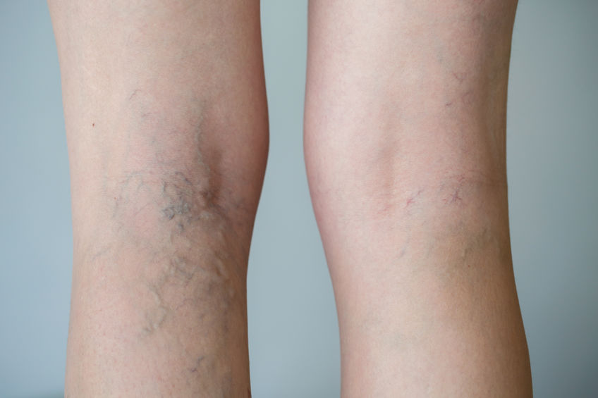 Spider Veins – Everything you need to know