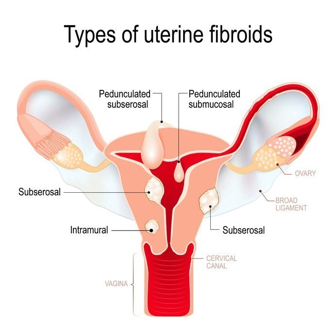 types of uterine fibroids: subserosal, intramural, submucosal, a
