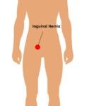 Inguinal-Hernia