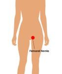 Inguinal-Hernia-female