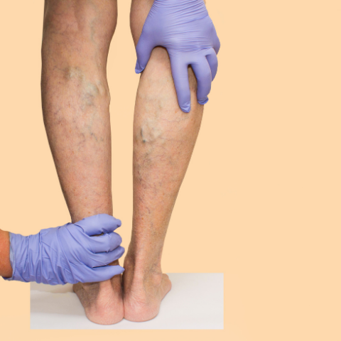 Varicose Veins: FAQs that you might have in mind