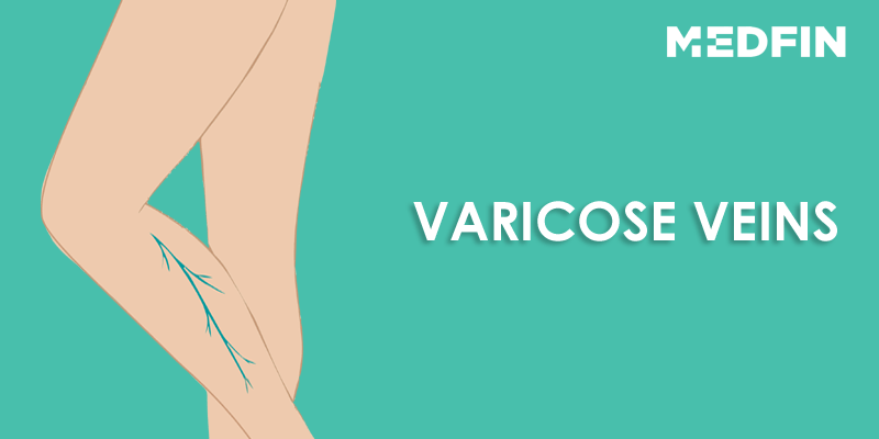 Varicose Veins: Should I be concerned about Varicose Veins?