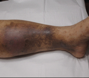 Skin Discoloration: Varicose Veins Stage 3