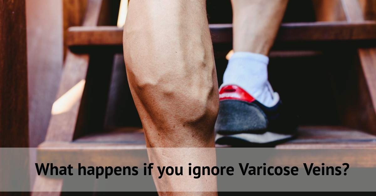 Ignore varicose veins? What can happen?