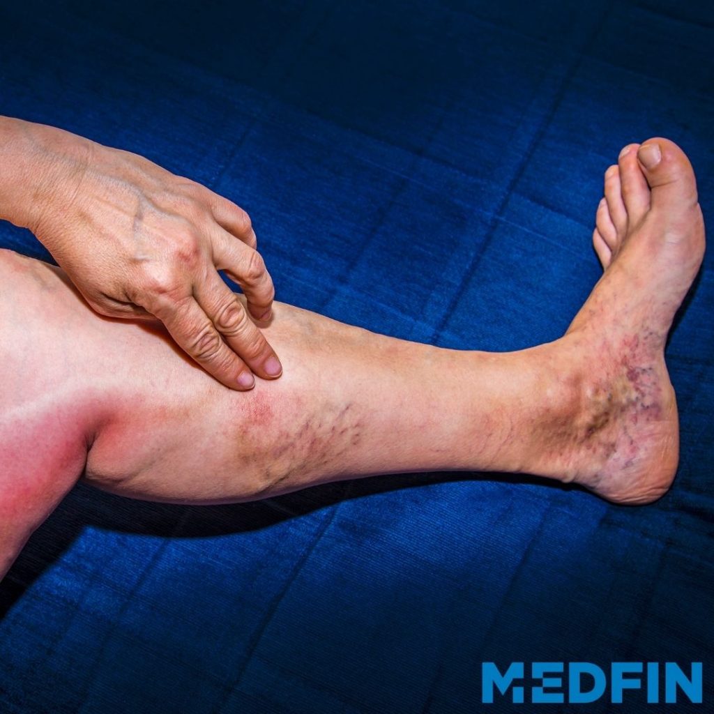 How to Prevent Varicose Veins in Kannada