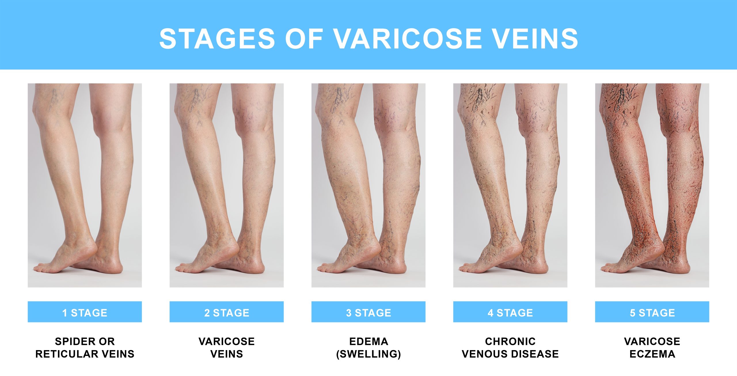 Nursing Paper Example on Varicose Veins