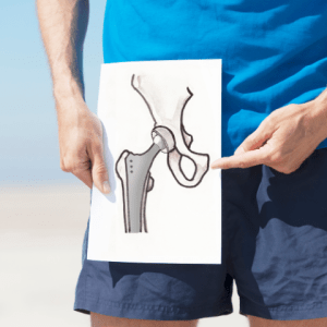 Hip-replacement