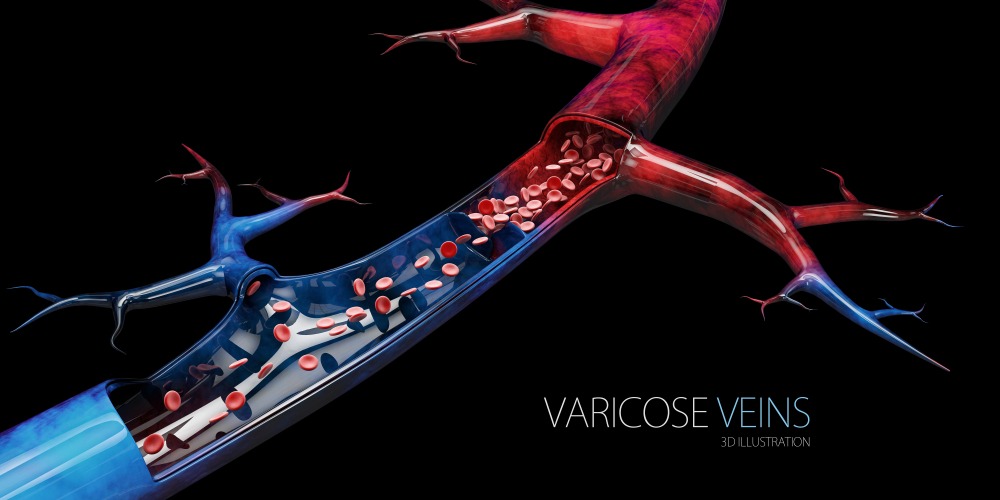 Varicose Veins: Everything that you need to know