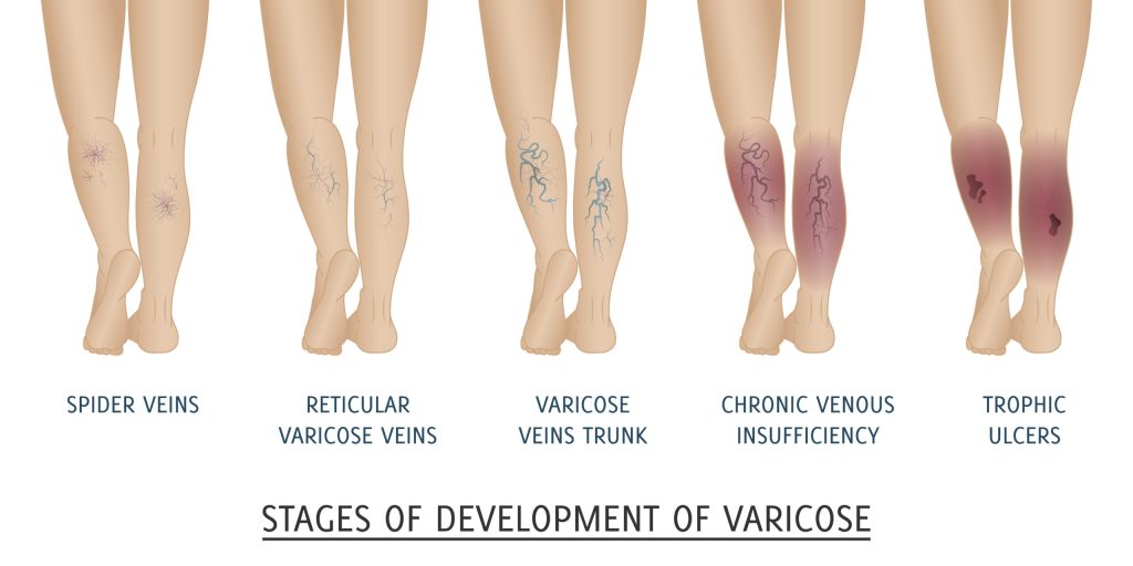 varicose-veins-types-overview-scaled-1-1024x512