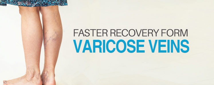vericose-veins-recovery