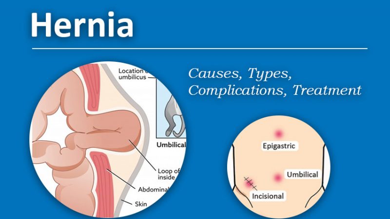 hernia causing factor
