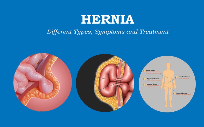 Types of Hernia: Everything you need to know
