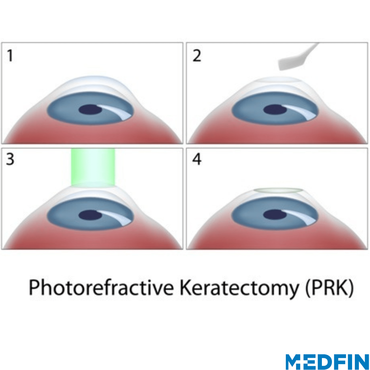 Medfin Stories: Patient Testimonial for PRK Laser eye surgery