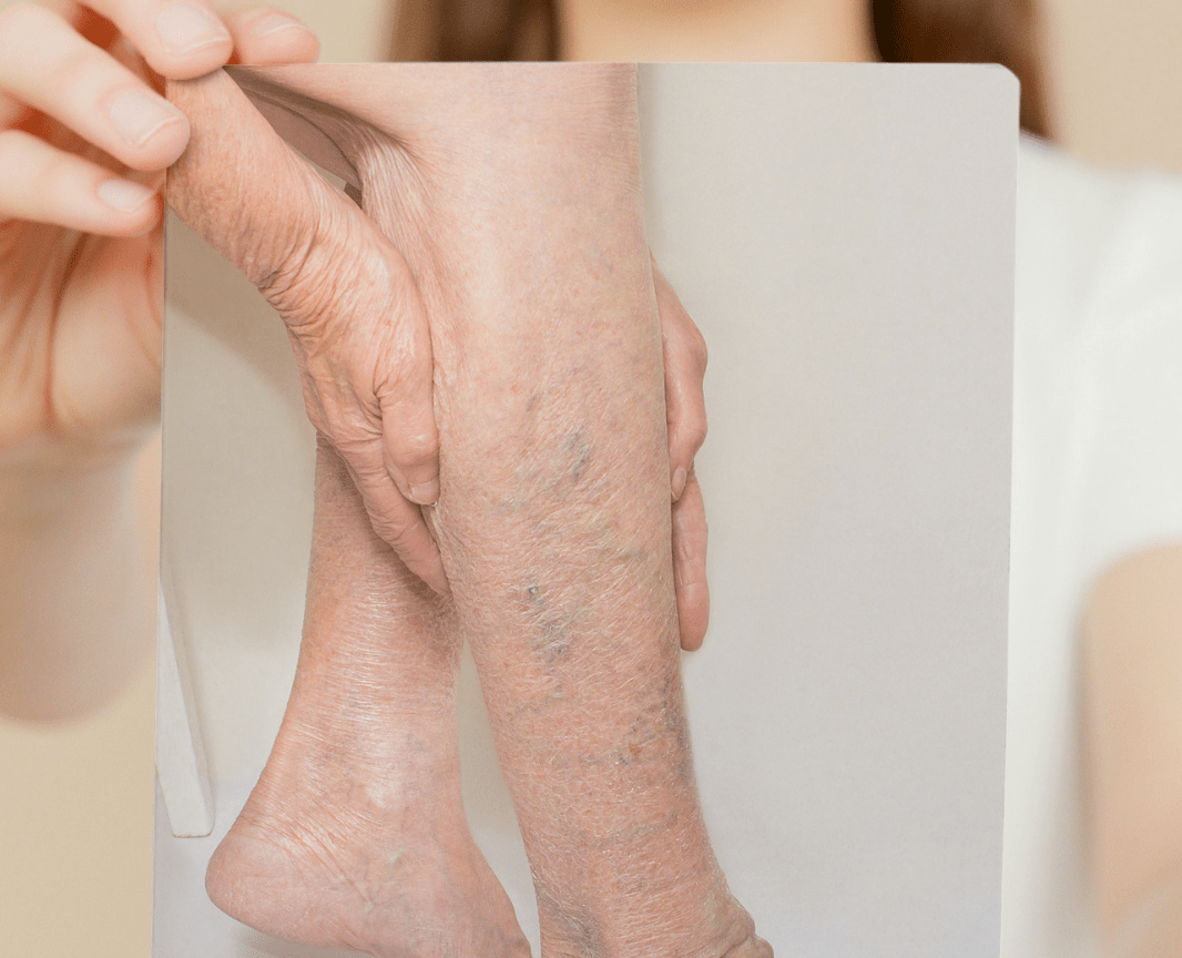 health  Looking for an effective treatment for Varicose Veins