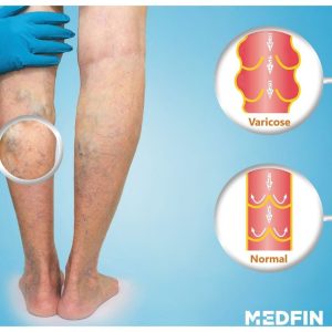 Home Remedies for Varicose Veins
