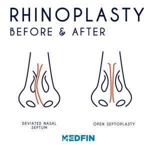 Rhinoplasty-before-and-after-square-image-300x300