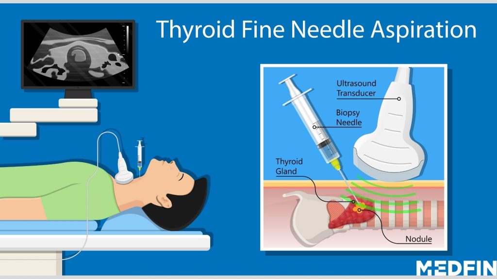 Thyroid: Diagnosis, Treatment and Recovery Explained