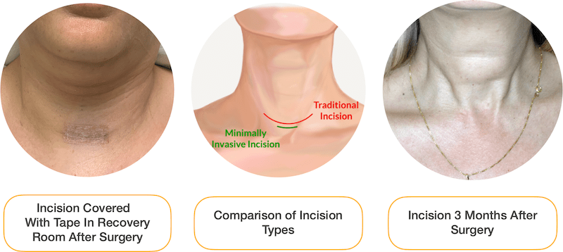 Thyroidectomy-Recovery
