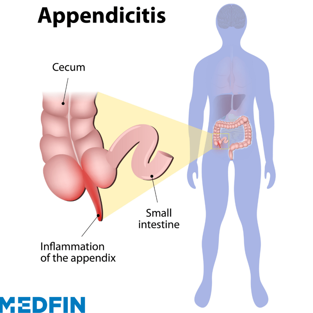 Appendicitis2