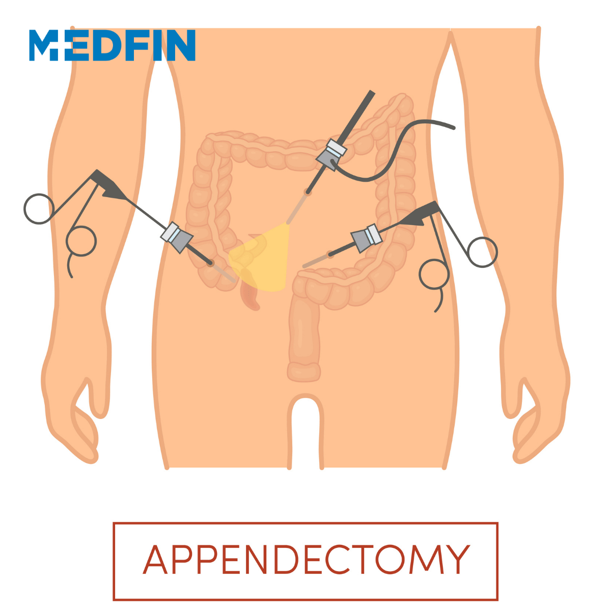 Appendicitis – Diagnosis, Treatment and Recovery