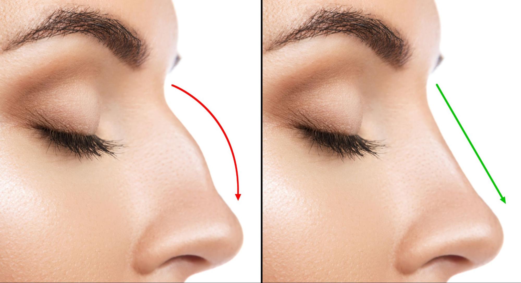 Rhinoplasty: What to Expect Before and After a Nose Job