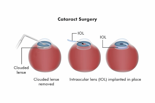 Which Lens Is Better For Cataract Surgery, Indian Or Imported?