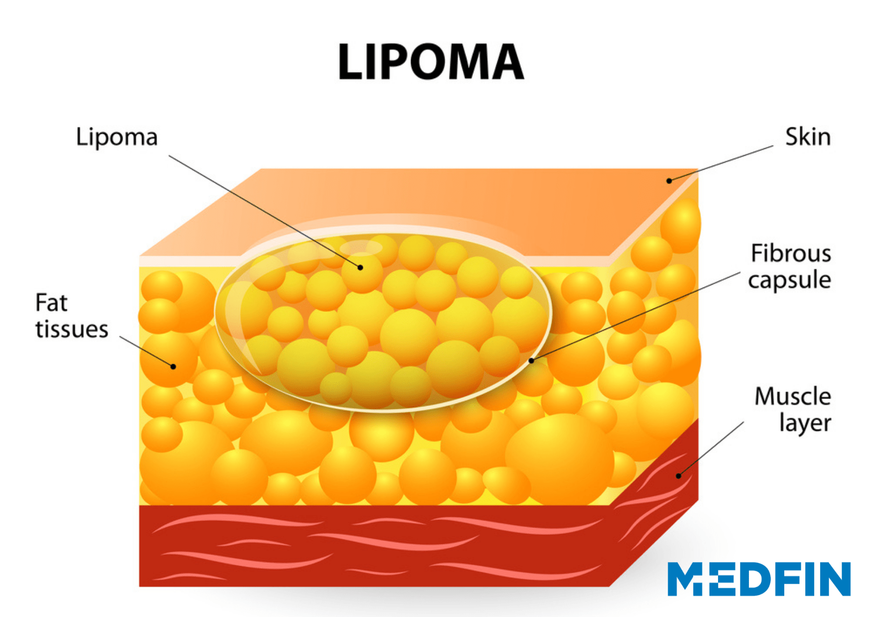 Lipoma1