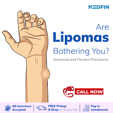 lipoma-treatment