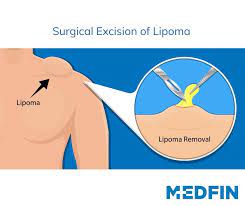 What to Expect After A Lipoma Surgery?