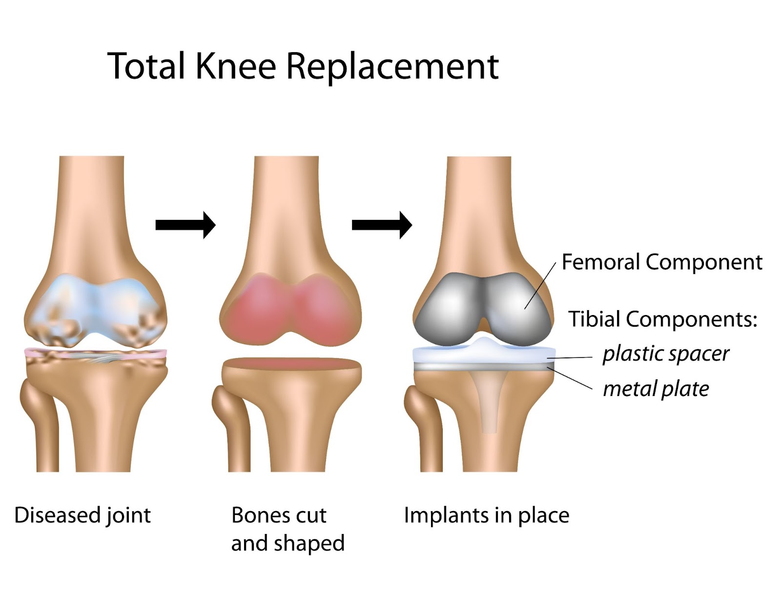 What Happens After Total Knee Replacement Surgery? Do I Need Physical  Therapy, And If So, For How Long? 