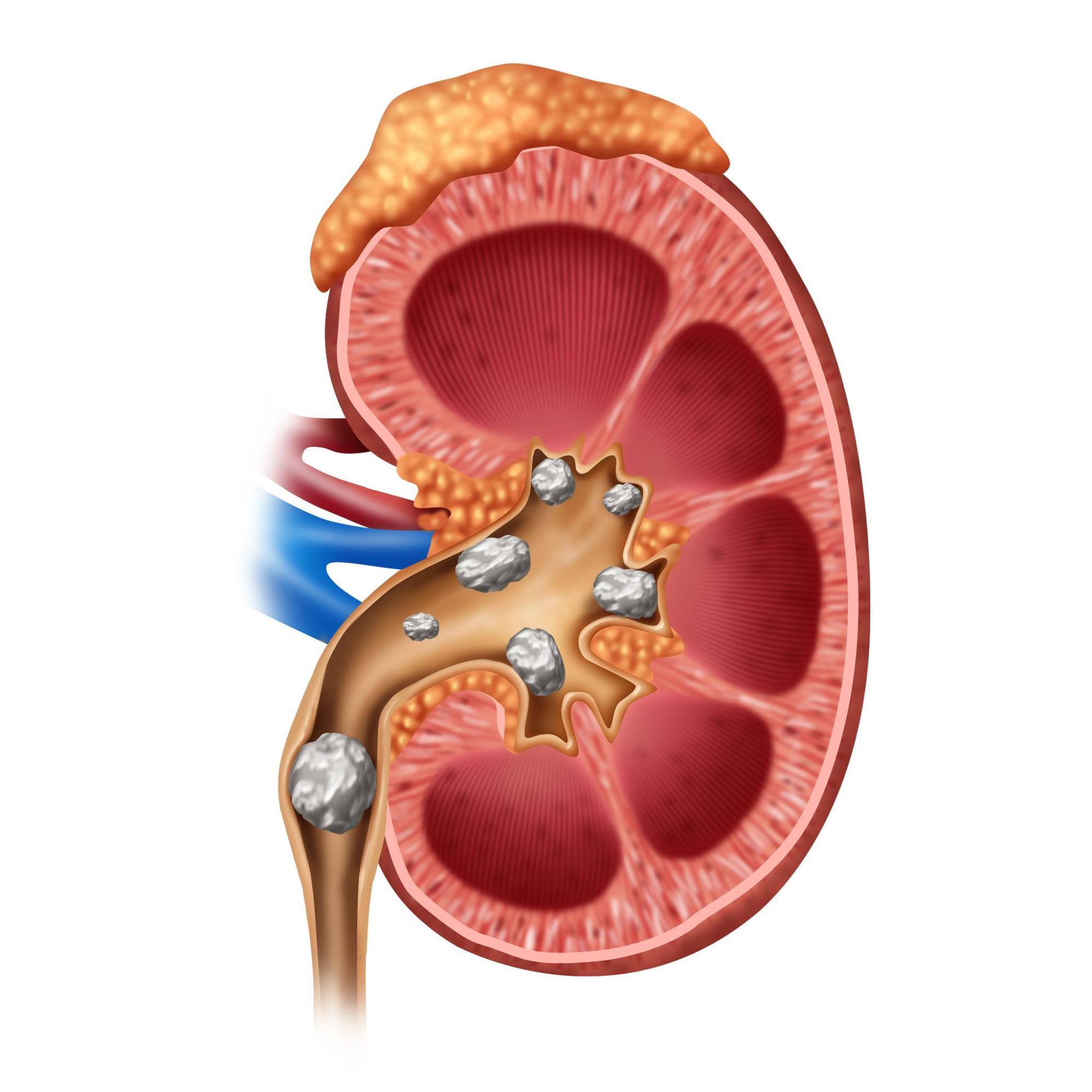 painfull kidney stone