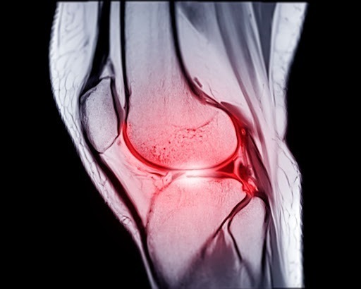 Anticipate the after effects of ACL surgery.
