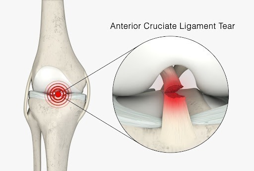 What Is ACL Reconstruction - Understanding The Basics