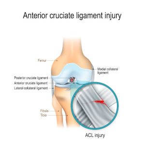 Managing Pain and Swelling after ACL Surgery: Tips and Strategies