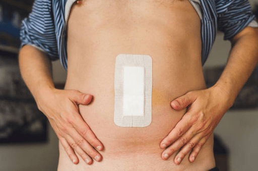 What is Hernia Surgery?