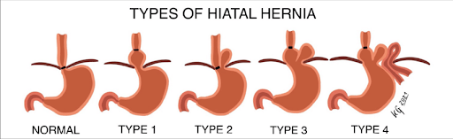 types-of-Hiatal-Hernia