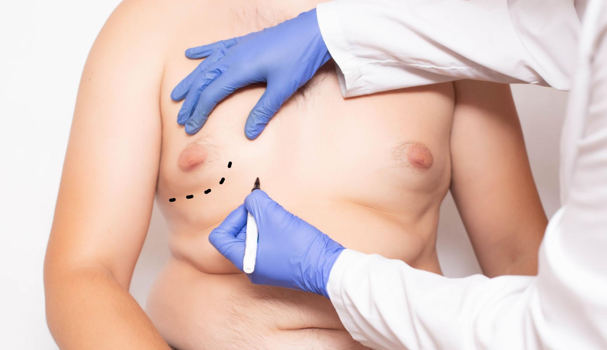 A Comprehensive Look at the Types of Gynecomastia Tissue