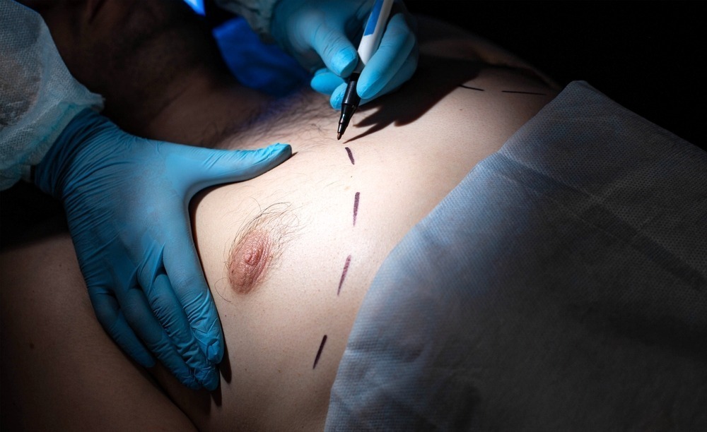 Do You Need Gynecomastia Surgery Or Liposuction?