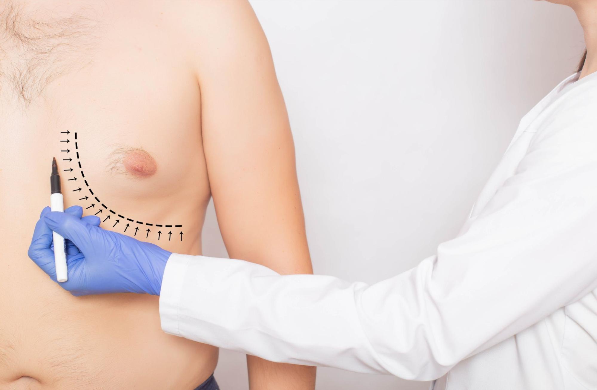 Scar Tissue Formation After Gynecomastia Surgery: Is it Normal?