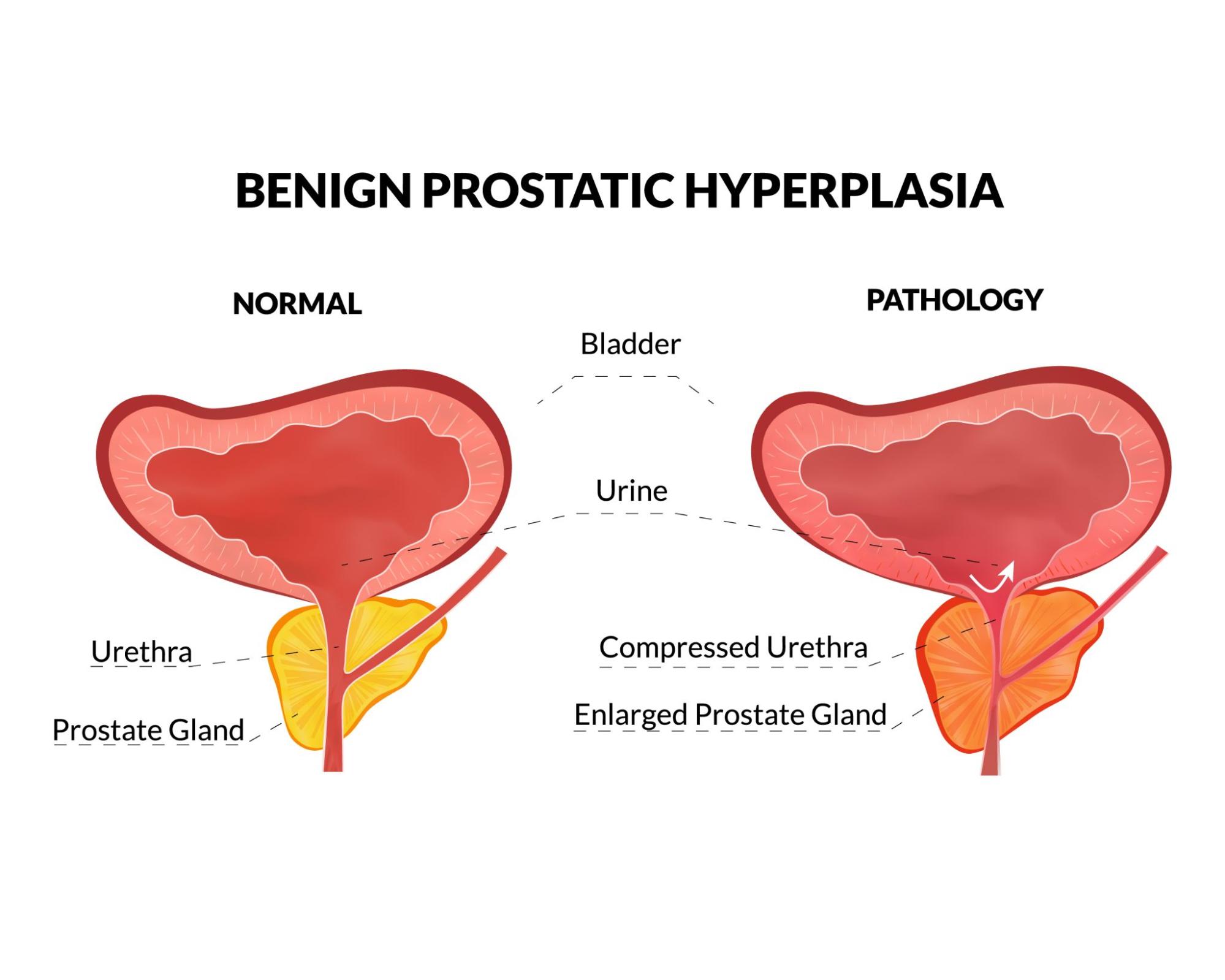Recognizing the Early Signs of Benign Prostatic Enlargement