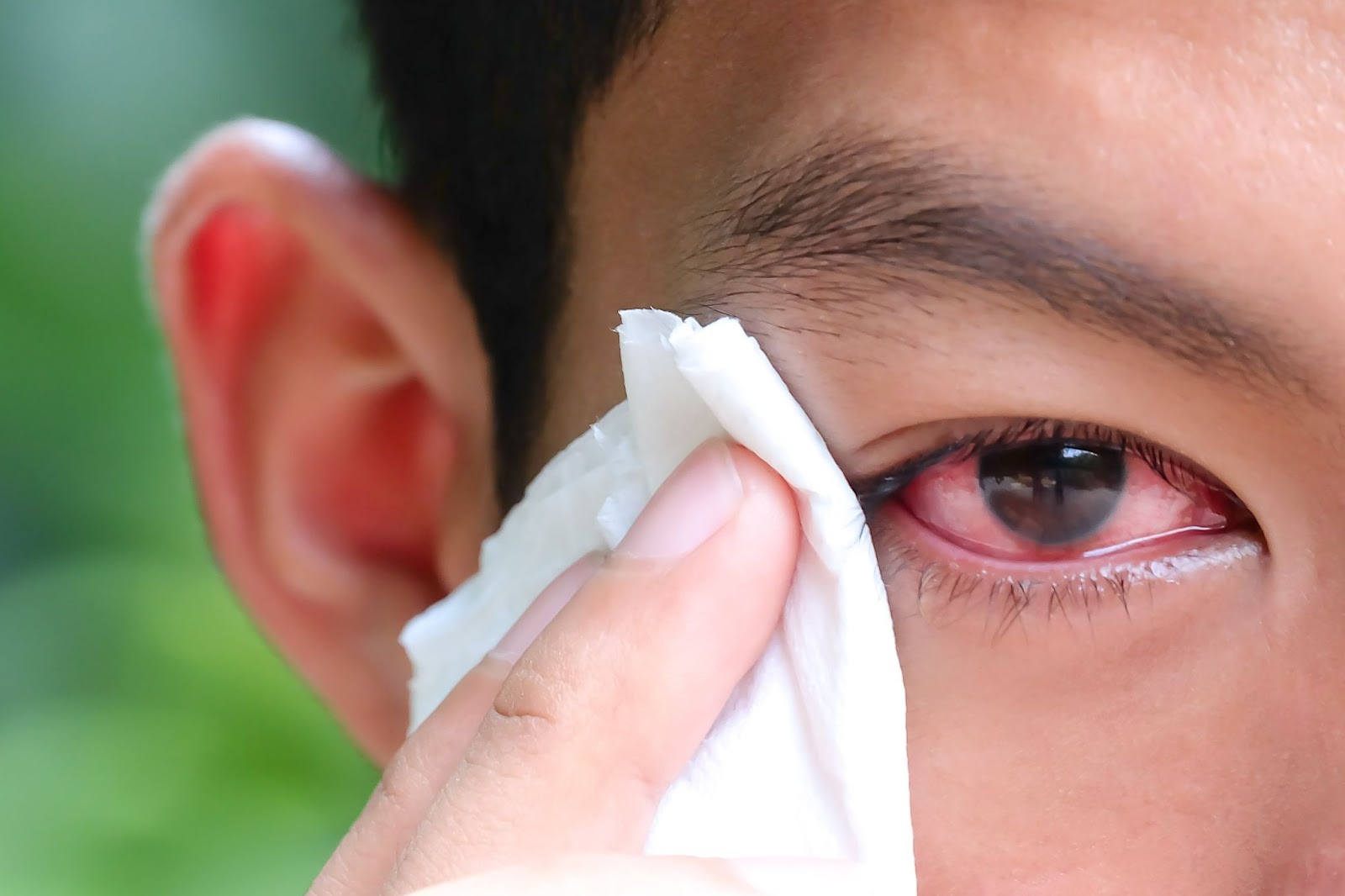 Madras EYE (Conjunctivitis) – Symptoms, Types and Treatments