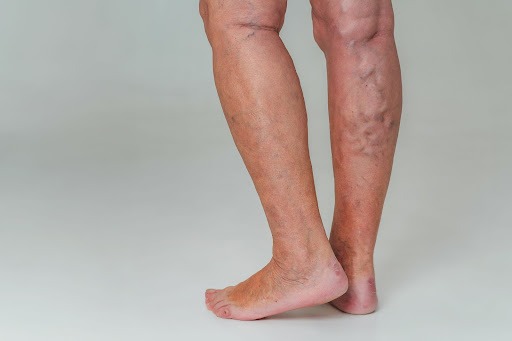 Muscular Legs Drawing - Causes & Best Homeopathic Medicines