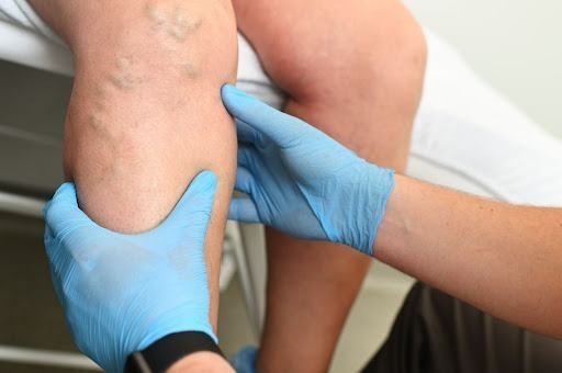 What Happens When a Varicose Vein Pops?