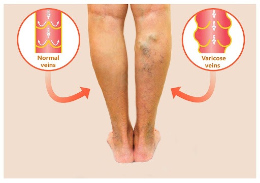 A Route to Correct Treatment For Varicose Veins