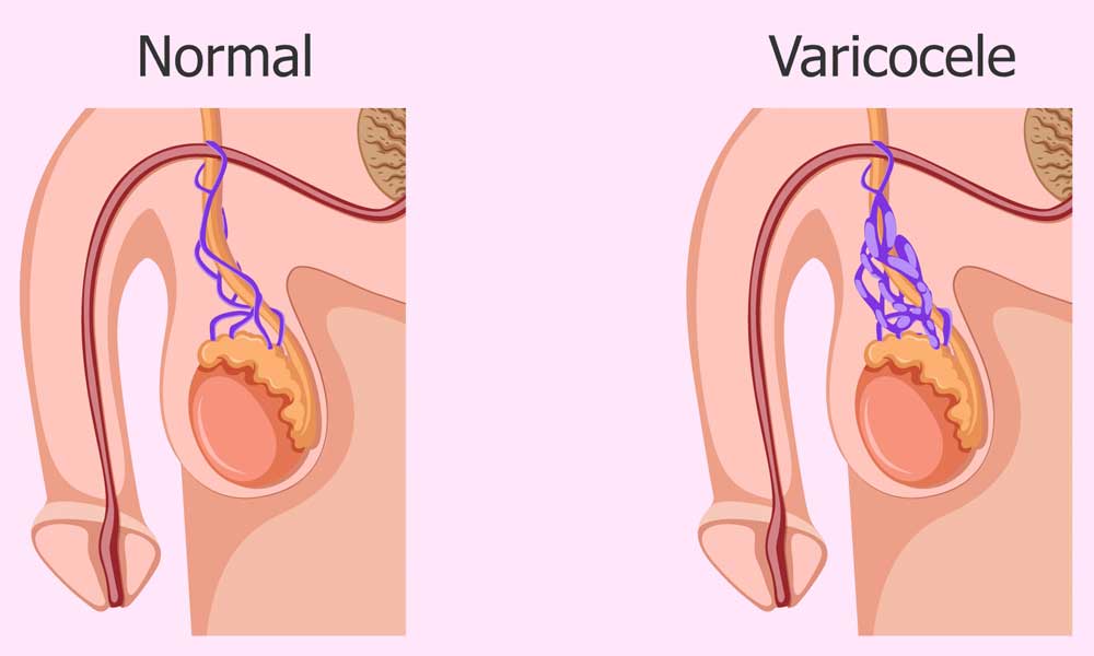 What is the recommended treatment for varicocele to assist with