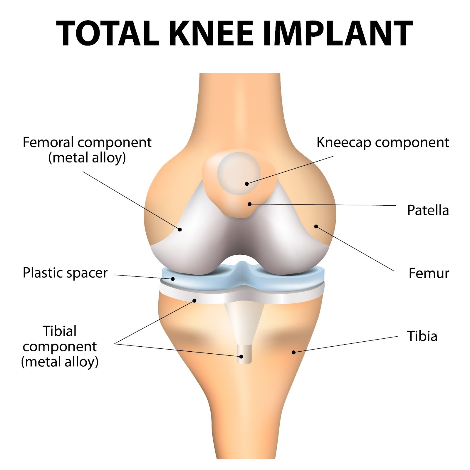 Total Knee Replacement Surgery Recovery