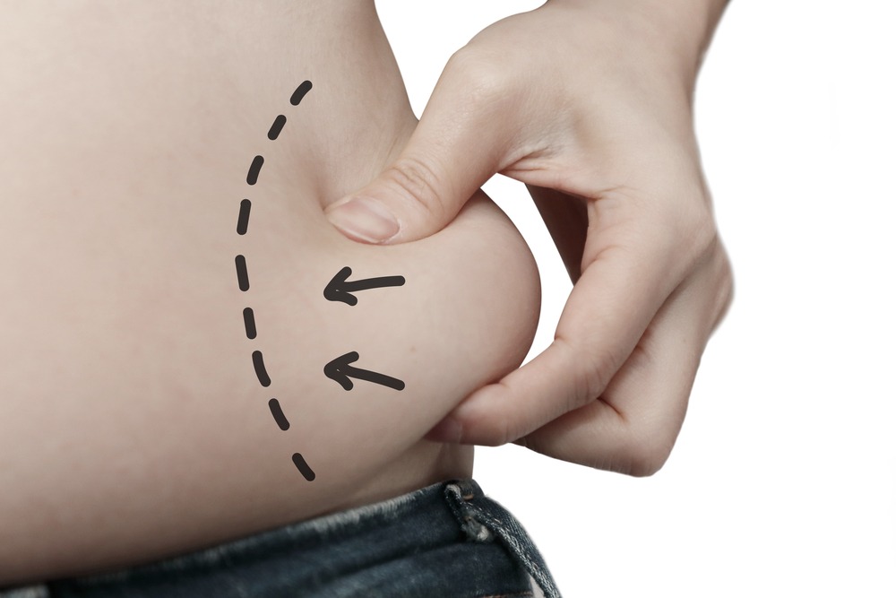 Liposuction: All That You Need To Know